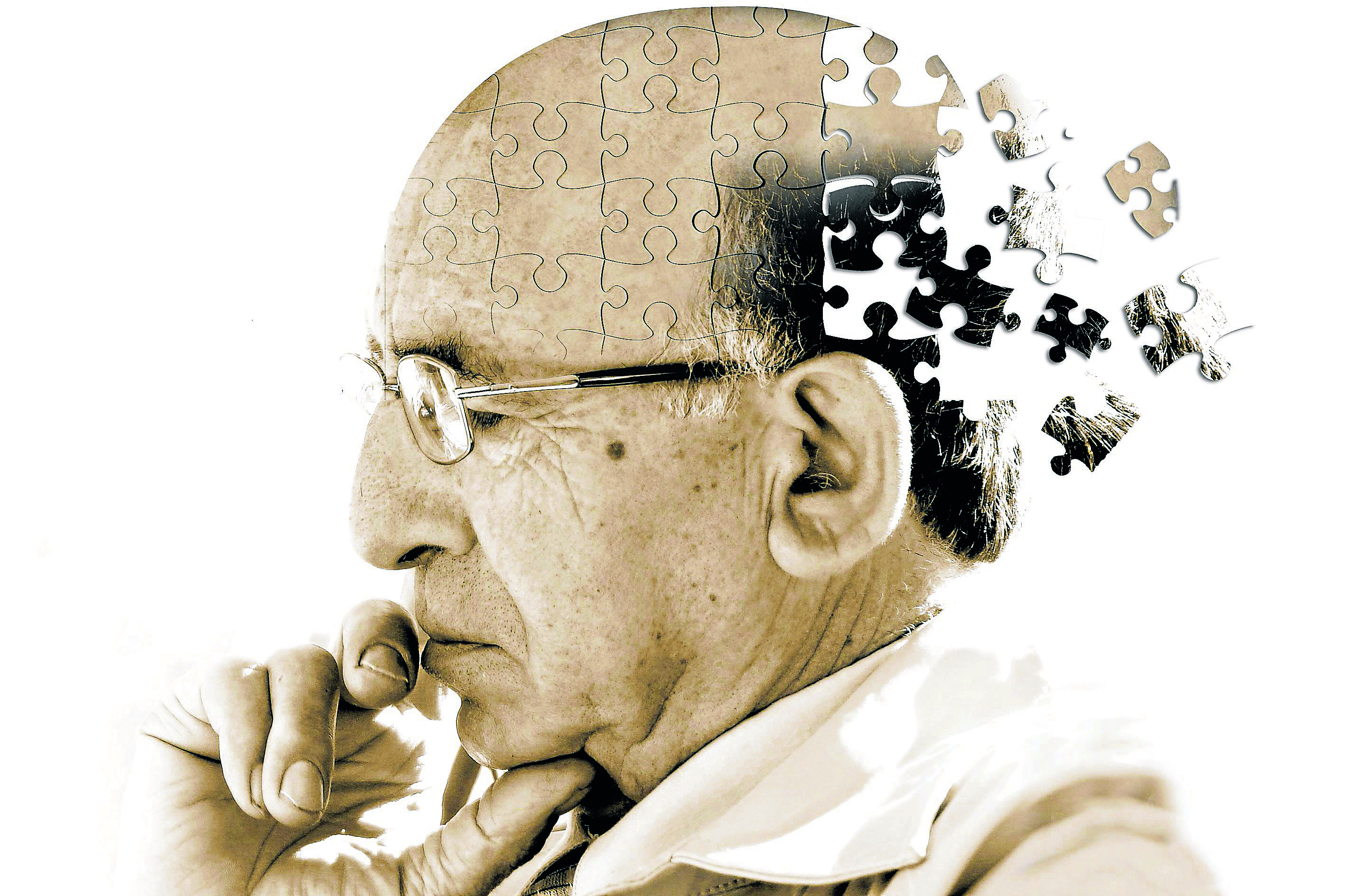 Слабоумие картинки. Деменция Альцгеймера. Альгеймер. Люди с Альцгеймером. Психология старости.